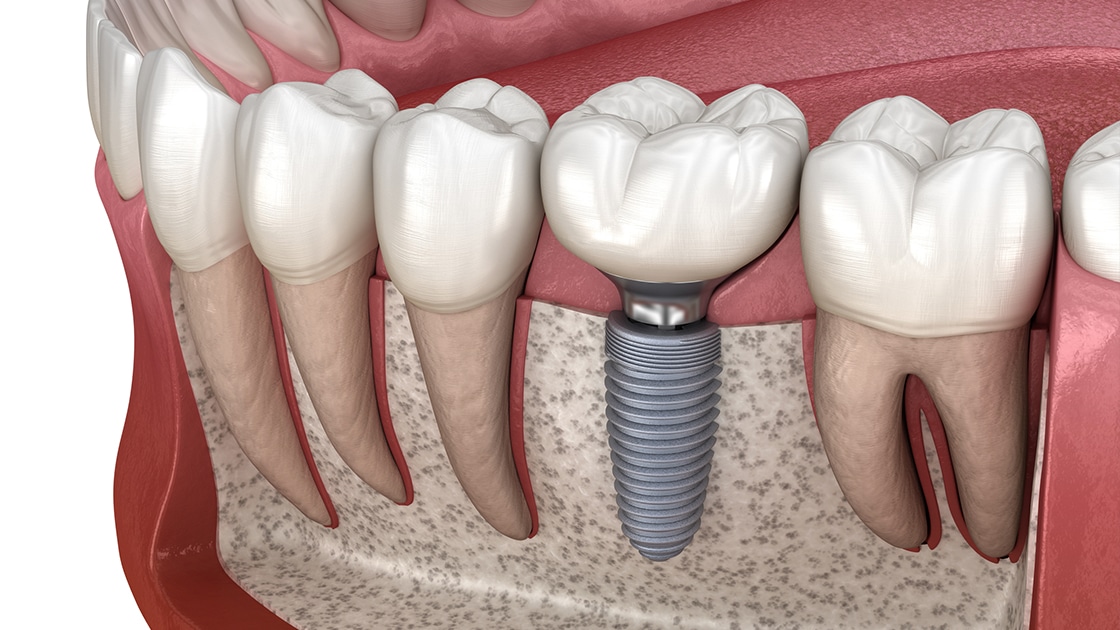 Dental Implant Care and Maintenance Tips.